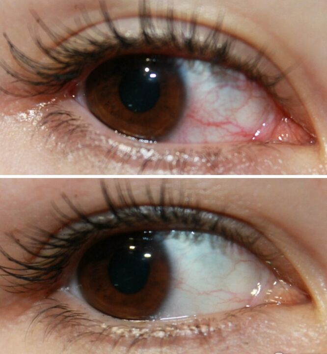Ocuvit agisce molto rapidamente